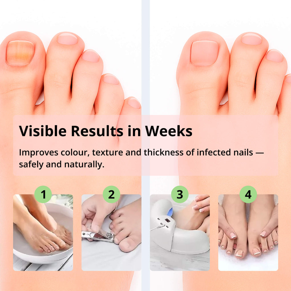 Laser Nail Fungus Removal Device