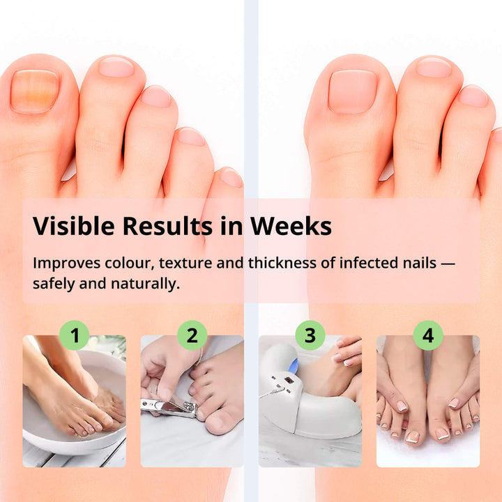 Laser Nail Fungus Removal Device