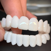 SmileFlex – Customisable Denture with Dental Veneers