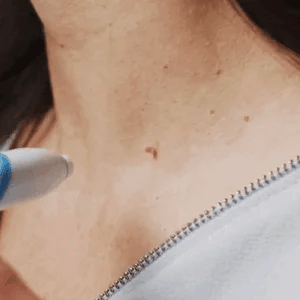 TagGone Automatic Skin Tag Removal Kit | Painless Application | For Smooth, Even Skin