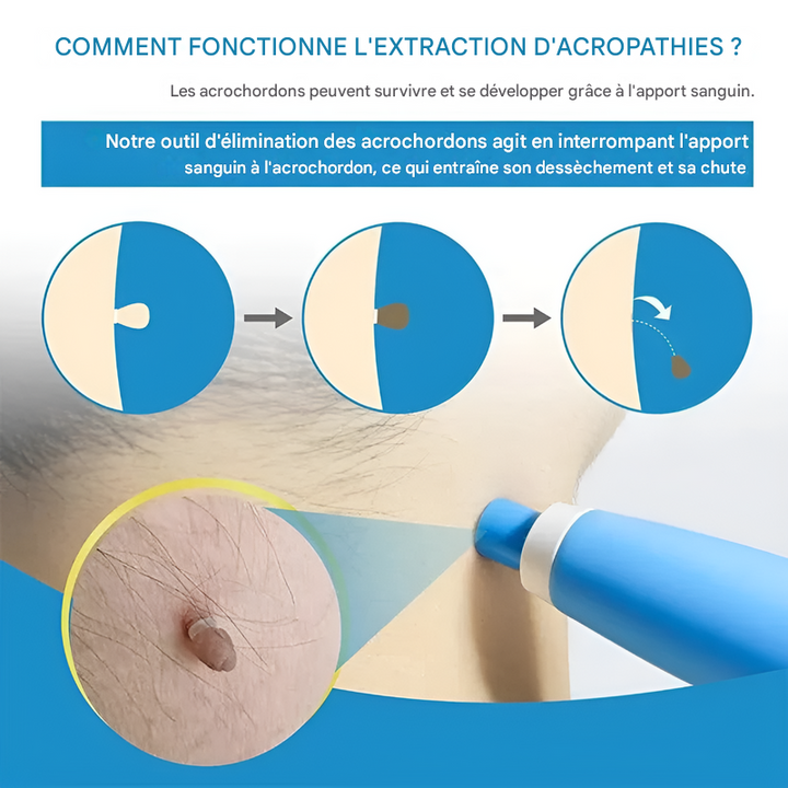 Skin Tag Removal Kit - Simple Cryotherapy