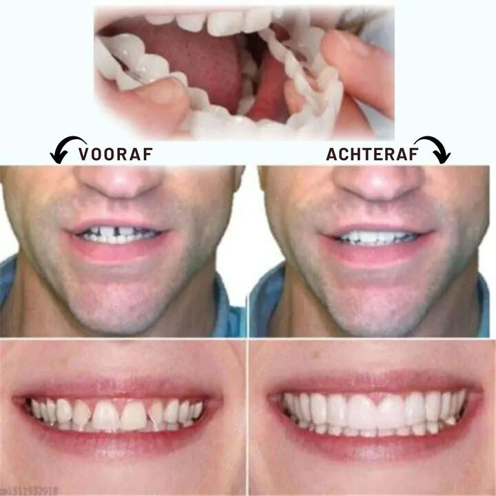 Snap-On Dental Veneers | Adjustable